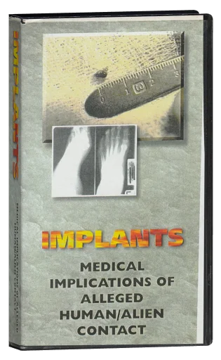 Alien Implants: Medical Implications Of Alleged Human/Alien Contact